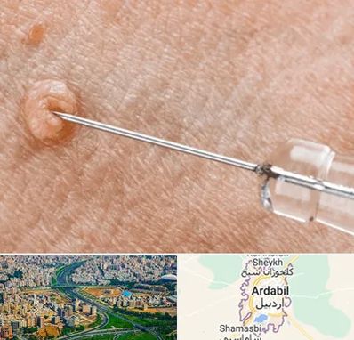 لیزر زگیل تناسلی در اردبیل