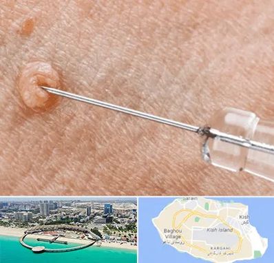 لیزر زگیل تناسلی در کیش