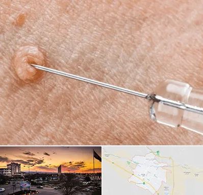 لیزر زگیل تناسلی در قوچان