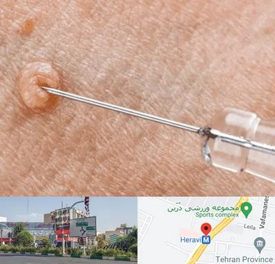 لیزر زگیل تناسلی در هروی 