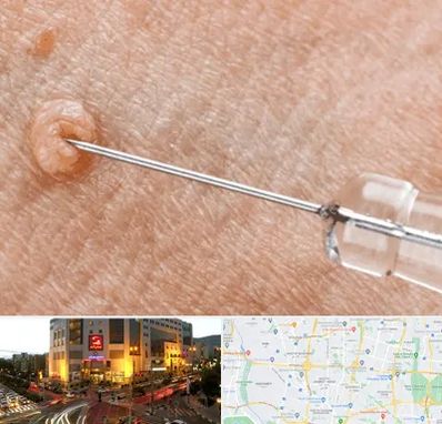 لیزر زگیل تناسلی در جنت آباد تهران 