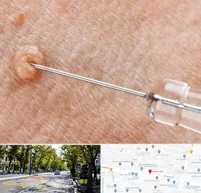 لیزر زگیل تناسلی در میرداماد 