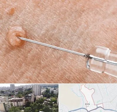 لیزر زگیل تناسلی در اوین