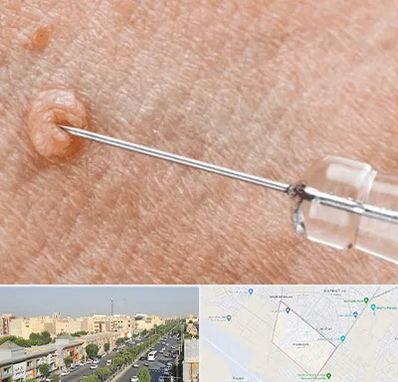 لیزر زگیل تناسلی در کیانمهر کرج 