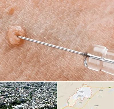 لیزر زگیل تناسلی در شاهرود