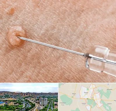 لیزر زگیل تناسلی در شهریار