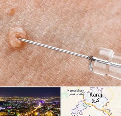 لیزر زگیل تناسلی در کرج