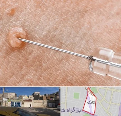 لیزر زگیل تناسلی در اتابک