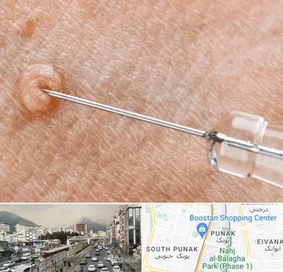 لیزر زگیل تناسلی در پونک 