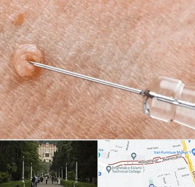 لیزر زگیل تناسلی در بلوار معلم رشت 