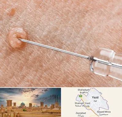 لیزر زگیل تناسلی در یزد