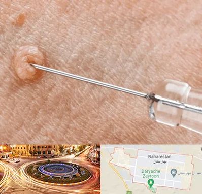 لیزر زگیل تناسلی در بهارستان