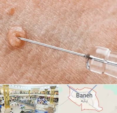 لیزر زگیل تناسلی در بانه