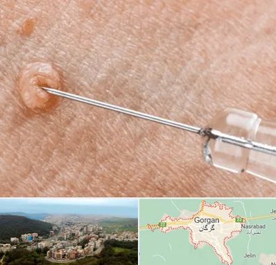 لیزر زگیل تناسلی در گرگان