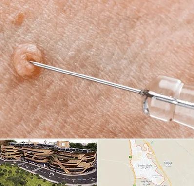 لیزر زگیل تناسلی در شاهین شهر