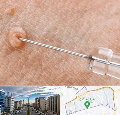 لیزر زگیل تناسلی در سعادت آباد 