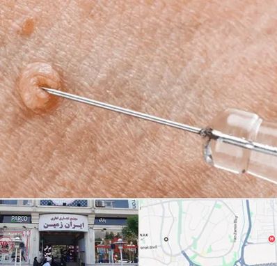 لیزر زگیل تناسلی در ایران زمین