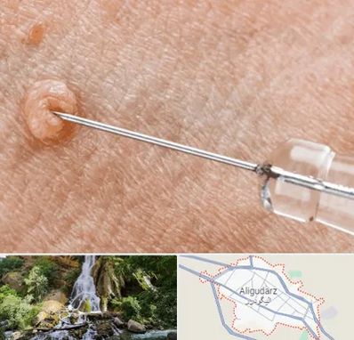 لیزر زگیل تناسلی در الیگودرز