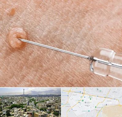 لیزر زگیل تناسلی در منطقه 8 تهران 