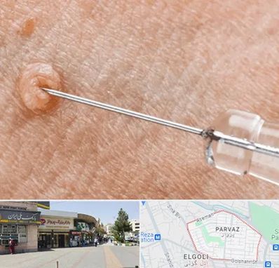 لیزر زگیل تناسلی در پرواز تبریز