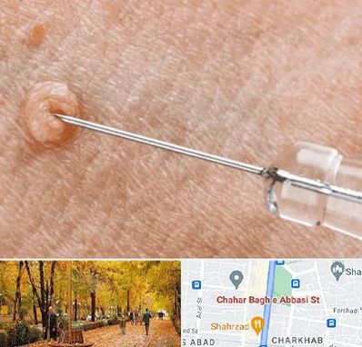 لیزر زگیل تناسلی در چهارباغ اصفهان 