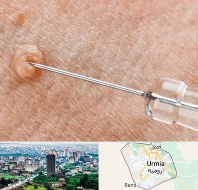 لیزر زگیل تناسلی در ارومیه