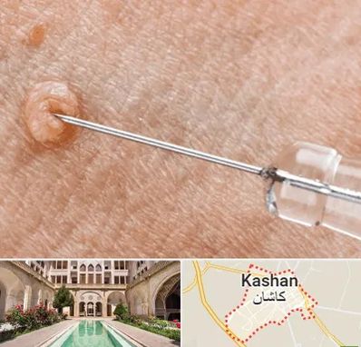 لیزر زگیل تناسلی در کاشان