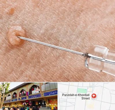 لیزر زگیل تناسلی در 15 خرداد