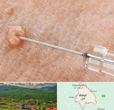 لیزر زگیل تناسلی در آمل