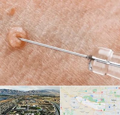 لیزر زگیل تناسلی در منطقه 21 تهران 