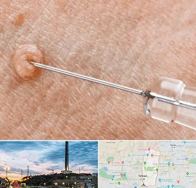 لیزر زگیل تناسلی در منطقه 2 تهران 