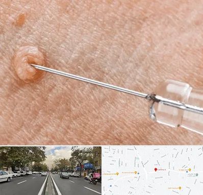 لیزر زگیل تناسلی در دولت 