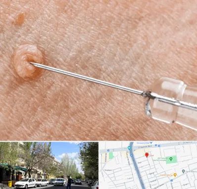 لیزر زگیل تناسلی در کوی فیروز تبریز