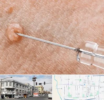 لیزر زگیل تناسلی در 17شهریور