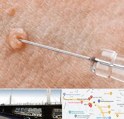 لیزر زگیل تناسلی در پارک وی 