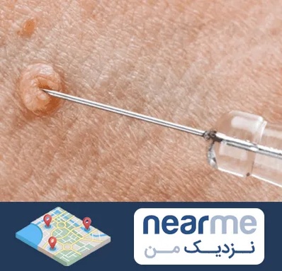 لیزر زگیل تناسلی در نزدیک من