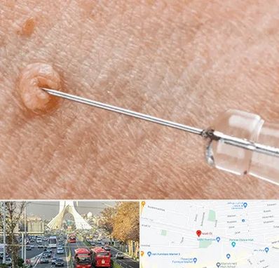 لیزر زگیل تناسلی در خیابان آزادی 