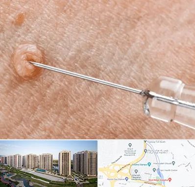 لیزر زگیل تناسلی در المپیک 