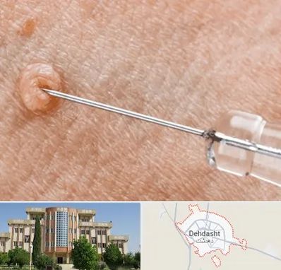 لیزر زگیل تناسلی در دهدشت