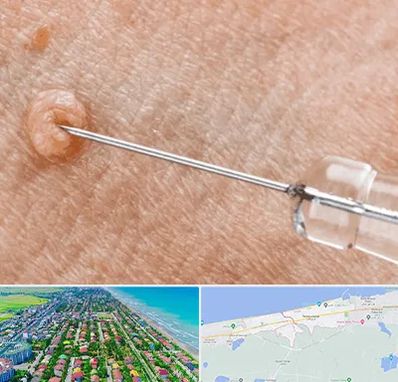 لیزر زگیل تناسلی در فریدونکنار