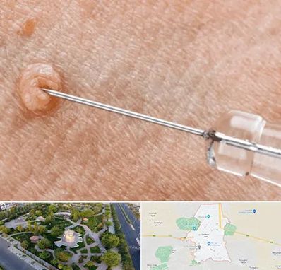 لیزر زگیل تناسلی در کاشمر