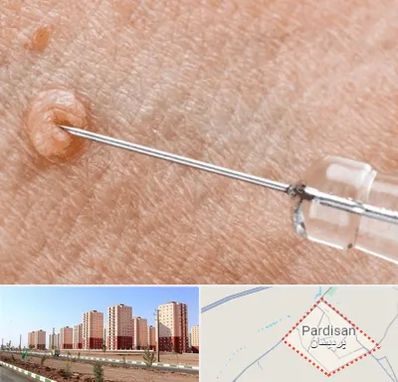 لیزر زگیل تناسلی در پردیسان قم