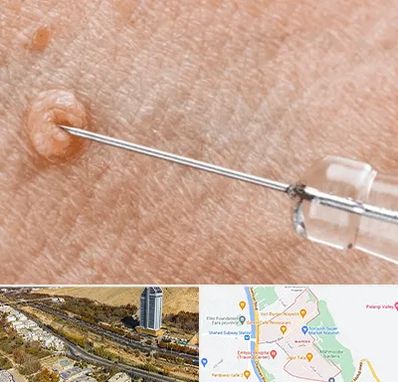 لیزر زگیل تناسلی در خیابان نیایش شیراز 