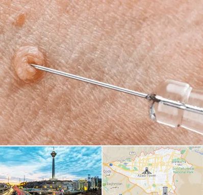 لیزر زگیل تناسلی در تهران