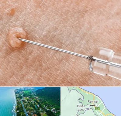 لیزر زگیل تناسلی در رامسر