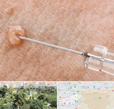 لیزر زگیل تناسلی در منطقه 13 تهران 