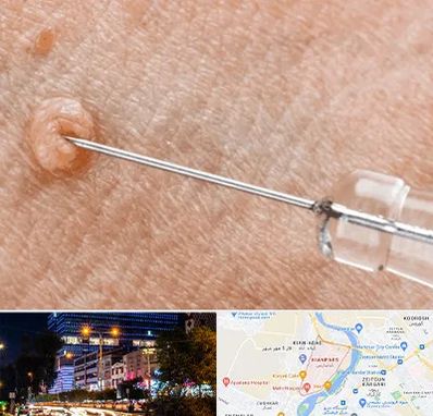 لیزر زگیل تناسلی در کیانپارس اهواز 