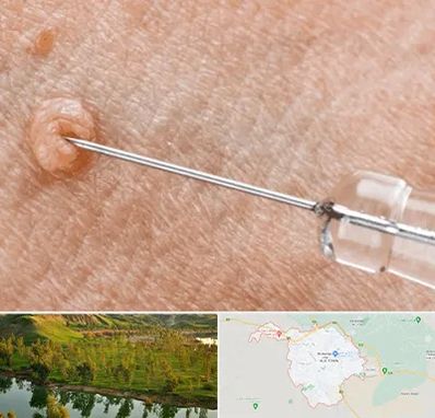 لیزر زگیل تناسلی در بهبهان