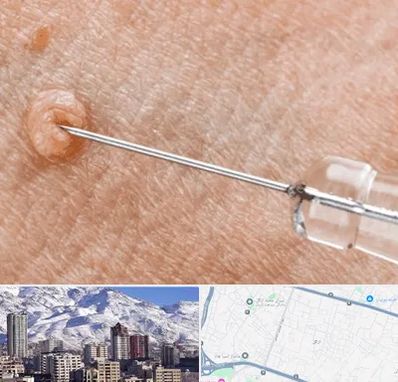 لیزر زگیل تناسلی در ازگل