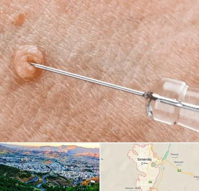 لیزر زگیل تناسلی در سنندج